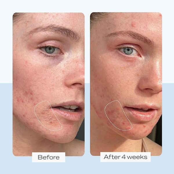 First Aid Beauty Ultra Repair Cream Intense Hydration Moisturizer for Face and Body - Image 2